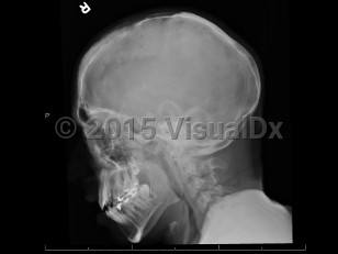 Imaging Studies image of Hypophosphatasia - imageId=7908095. Click to open in gallery.  caption: '<span>Osteopenia and thinning of the skull with a "beaten silver" appearance, which can be seen in the setting of hypophosphatasia.</span>'
