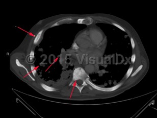 Imaging Studies image of Metastatic prostate carcinoma - imageId=7910099. Click to open in gallery.  caption: '<span>Axial CT scan through the chest  demonstrates widespread metastatic disease from prostate cancer with  innumerable pulmonary nodules, mediastinal adenopathy, and replacement of  all the bones by sclerotic metastases.</span>'