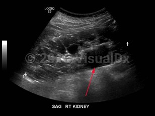 Imaging Studies image of Polycystic kidney disease - imageId=7911488. Click to open in gallery.  caption: '<span>Grayscale ultrasound image demonstrates enlarged right kidney with multiple cysts, some simple and others complex. The left kidney had a similar appearance.</span>'