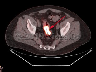 Imaging Studies image of Rectal carcinoma