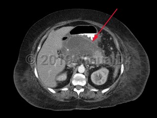 Imaging Studies image of Pancreatic pseudocyst