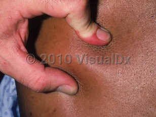 Clinical image of Scleredema - imageId=791395. Click to open in gallery.  caption: 'A close-up of firm, indurated skin.'