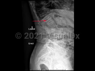 Imaging Studies image of Osteoporotic compression fracture