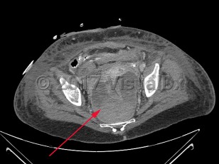 Imaging Studies image of Perirectal abscess