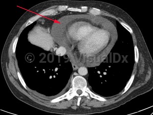 Imaging Studies image of Pericardial effusion - imageId=7915880. Click to open in gallery.  caption: '<span>Axial CT image with a moderate, simple pericardial effusion in this patient with lung cancer.</span>'