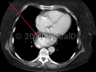 Imaging Studies image of Hiatal hernia - imageId=7915932. Click to open in gallery.  caption: '<span>Image from a CT scan of the abdomen demonstrating a large hiatal hernia.</span>'