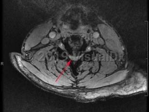 Imaging Studies image of Cervical spinal stenosis - imageId=7917503. Click to open in gallery.  caption: '<span>Axial GRE MRI sequence  demonstrates cervical spinal stenosis with severe central canal  narrowing secondary to a large posterior disc osteophyte complex which  impresses upon the ventral aspect of the thecal sac/spinal cord.</span>'