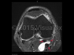 Imaging Studies image of Popliteal cyst