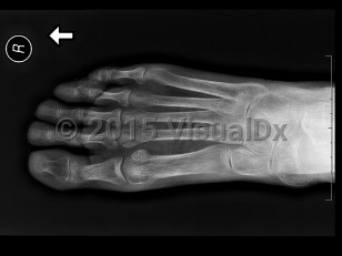 Imaging Studies image of Osteoporosis