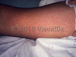 Clinical image of Zika virus infection - imageId=7934020. Click to open in gallery.  caption: 'Diffuse erythematous patches and plaques on the thigh.'