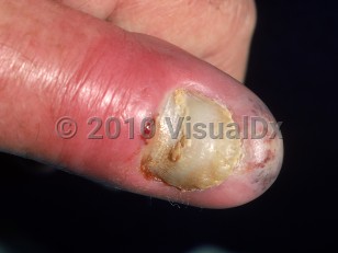 Clinical image of Felon - imageId=795890. Click to open in gallery.  caption: 'A bright red plaque on the distal finger with a dusky and whitish portion on the fingertip.'