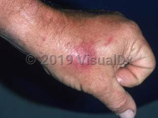 Clinical image of Coccidioidomycosis - imageId=797696. Click to open in gallery.  caption: 'A deep pink nodule on the dorsal hand.'