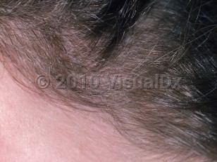 Clinical image of Trichorrhexis nodosa - imageId=798724. Click to open in gallery.  caption: 'Gray-white specks along some of the hair shafts on the frontal scalp.'