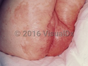 Clinical image of Propionic acidemia - imageId=799487. Click to open in gallery. 