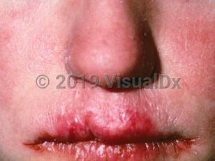 Clinical image of Chronic mucocutaneous candidiasis