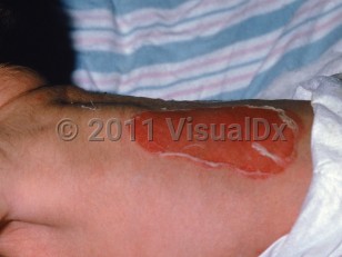 Clinical image of Junctional epidermolysis bullosa - imageId=801180. Click to open in gallery.  caption: 'A large superficial ulcer with peripheral peeling scale on the back.'
