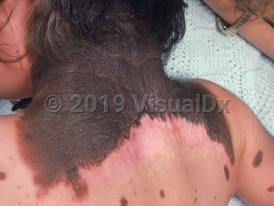 Clinical image of Giant congenital nevus - imageId=802946. Click to open in gallery.  caption: 'A giant congenital nevus involving the posterior neck and scalp with numerous satellite congenital nevi. Note also the scar at the inferior aspect of the giant nevus.'