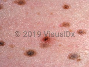 Clinical image of Familial atypical multiple mole-melanoma syndrome - imageId=806364. Click to open in gallery.  caption: 'A close-up of numerous homogenous and variegated brown macules, papules, and plaques. Note also the reddish papule with a central blackish color (the "ugly duckling"- suspicious for melanoma).'