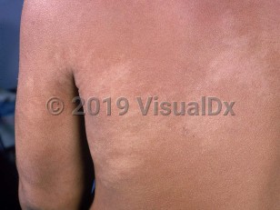 Clinical image of Nevus depigmentosus - imageId=807042. Click to open in gallery.  caption: 'Subtle, large, hypopigmented patches with feathery borders, on the back and arm.'