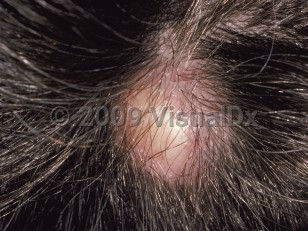 Clinical image of Pilar cyst - imageId=80847. Click to open in gallery.  caption: 'A yellowish nodule with overlying diminished hair growth on the scalp.'