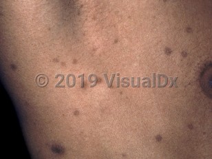 Clinical image of Postinflammatory hyperpigmentation - imageId=815538. Click to open in gallery.  caption: 'Scattered, dark brown macules on the lateral chest.'