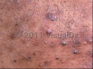 Clinical image of Steroid acne