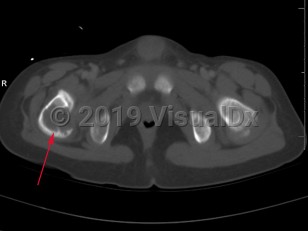 Imaging Studies image of Eosinophilic granuloma of bone - imageId=8322100. Click to open in gallery.  caption: '<span>Axial CT of the pelvis  demonstrates a large lytic lesion involving the right hip with cortical  destruction. This pediatric patient also had multiple other sites of  lytic lesions, including the skull. Given the constellation of findings,  this is most compatible with an eosinophilic granuloma.</span>'