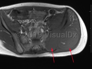 Imaging Studies image of Ewing sarcoma - imageId=8322684. Click to open in gallery.  caption: '<span>Axial T1 MRI sequence demonstrates an infiltrative low/intermediate T1 signal mass involving the left iliac bone with cortical destruction, and an associated soft tissue mass extending into the gluteal and iliacus musculature (with small areas of hemorrhagic necrosis). Biopsy of this mass showed Ewing sarcoma.</span>'