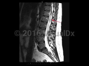 Imaging Studies image of Cauda equina syndrome - imageId=8332657. Click to open in gallery.  caption: '<span>Sag T2 MRI sequence of the  lumbar spine demonstrates a mass with increased T2 signal involving the  terminal aspects of the conus medullaris, with expansion of the cord and  perilesional edema. This mass was found to represent an astrocytoma, and  was resulting in symptoms of cauda equina syndrome secondary to  compression of the cauda equina.</span>'