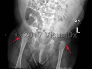 Imaging Studies image of Developmental dysplasia of the hip