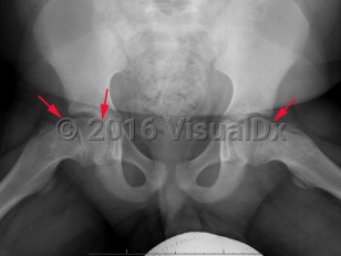 Imaging Studies image of Slipped capital femoral epiphysis - imageId=8338297. Click to open in gallery.  caption: '<span>Widening and irregularity of  the right hip physis, with mild posteromedial slip of the epiphysis  relative to the metaphysis. Findings are compatible with SCFE. Note the  normal appearance of the left hip physis.</span>'