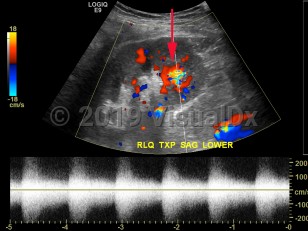 Imaging Studies image of Arteriovenous fistula - imageId=8339198. Click to open in gallery.  caption: '<span>Color and spectral Doppler image of a renal transplant status post biopsy. There is a focal region of color in the lower pole with low resistance spectral waveform, consistent with arteriovenous fistula.</span>'