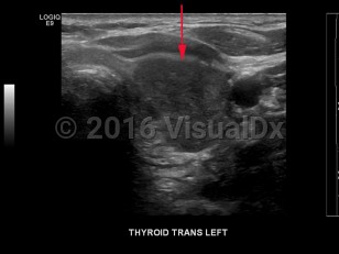 Imaging Studies image of Thyroid cancer - imageId=8340636. Click to open in gallery.  caption: '<span>Grayscale transverse ultrasound image of the thyroid gland demonstrates a large, hypoechoic  mass in the left lobe. Biopsy proven medullary  thyroid cancer.</span>'