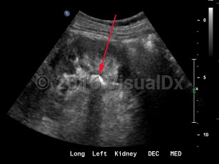Imaging Studies image of Renal calculus - imageId=8341825. Click to open in gallery.  caption: '<span>Grayscale ultrasound of the left kidney demonstrates an echogenic focus in the lower pole with shadowing artifact.</span>'