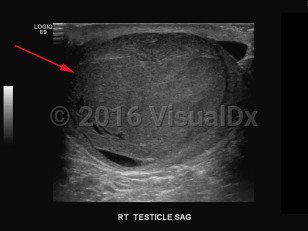 Imaging Studies image of Testicular cancer - imageId=8342371. Click to open in gallery.  caption: '<span>Grayscale ultrasound image of the right testicle demonstrating a large heterogeneous mass occupying the entire testicle. Path proven classic seminoma.</span>'