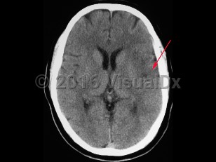 Imaging Studies image of Cerebral stroke