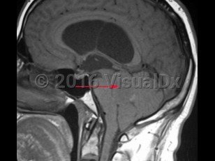 Imaging Studies image of Ependymoma - imageId=8342748. Click to open in gallery.  caption: '<span>T1 weighted sagittal MRI demonstrating ependymoma of the fourth ventricle.</span>'