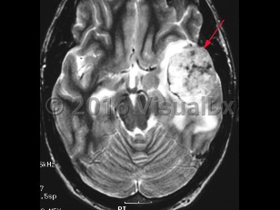 Imaging Studies image of Glioblastoma multiforme - imageId=8343053. Click to open in gallery.  caption: '<span>T2 weighted axial MRI demonstrating left-sided glioblastoma multiforme.</span>'
