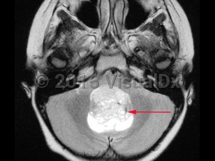 Imaging Studies image of Medulloblastoma - imageId=8343471. Click to open in gallery.  caption: '<span>Axial MRI demonstrating hyperintense medulloblastoma in the posterior fossa in a pediatric patient.</span>'