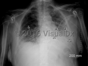 Imaging Studies image of Acute interstitial pneumonia - imageId=8345960. Click to open in gallery.  caption: '<span>Single portable semi-upright  AP view of the chest. There are bilateral airspace opacities with a  predominantly lower lobe distribution, left greater than right (straight  black arrows). An air bronchogram is also evident within the left lung  (straight white arrow). There is a craniocaudal gradation of density  which suggests pleural effusions, although this is difficult to  appreciate on a semi-recumbent exam (curved white arrow). Follow-up CT  confirmed bilateral pleural effusions, left greater than right.</span>'