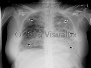 Imaging Studies image of Acute respiratory distress syndrome - imageId=8346315. Click to open in gallery.  caption: '<span>Single portable recumbent AP  view of the chest. A second radiograph obtained 8 hours after initial  radiograph demonstrates diffuse, bilateral airspace opacities, left  greater than right (straight black arrows). In the left hemithorax,  where fewer airspace opacities obscure the periphery of the lung, there  is no convincing evidence of Kerley B lines or pleural thickening (as  one might see in hydrostatic pulmonary edema).</span>'