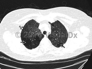 Imaging Studies image of Bronchiolitis obliterans - imageId=8347118. Click to open in gallery.  caption: '<span>Axial 0.90mm slice thickness  non-contrast CT image of the chest viewed in lung windows in the upper  chest. Axial CT image of the chest demonstrates mosaic attenuation  throughout both lungs, with geographic areas of decreased attenuation  (straight black arrows) and decreased vascularity (straight white  arrow).</span>'