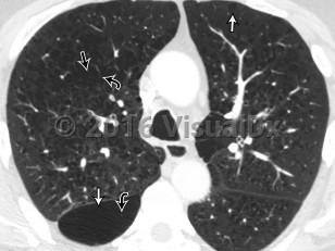 Imaging Studies image of Chronic obstructive pulmonary disease - imageId=8353431. Click to open in gallery.  caption: '<span>Axial non-contrast CT image of the chest viewed in lung windows in the upper lungs. CT image demonstrates several well-defined regions of low attenuation, both centrilobular (straight black arrow) and paraseptal (straight white arrows) distribution consistent with emphysema. Vessels course through several of these regions (curved black arrows), confirming that these areas reflect parenchymal loss rather than cysts (also note the lack of walls). There is severe airways thickening and mucous plugging, compatible with chronic bronchitis.</span>'