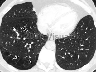 Imaging Studies image of Pulmonary emphysema - imageId=8353597. Click to open in gallery.  caption: '<span>Axial non-contrast CT image of the chest viewed in lung windows in the lower lungs. CT image demonstrates several well-defined regions of low attenuation, both centrilobular (straight black arrow) and paraseptal (straight white arrow) distribution consistent with emphysema. Vessels course through several of these regions (curved black arrow), confirming that these areas reflect parenchymal loss rather than cysts (also note the lack of walls). There is severe airways thickening and mucous plugging, compatible with chronic bronchitis.</span>'