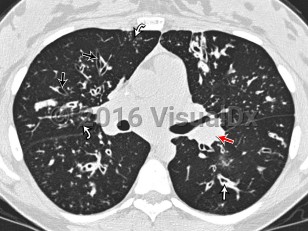 Imaging Studies image of Cystic fibrosis