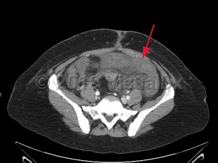 Imaging Studies image of Acute mesenteric ischemia - imageId=8357340. Click to open in gallery.  caption: '<span>Enhanced CT scan of the abdomen showing low attenuation wall thickening throughout the small bowel with mesenteric edema and decrease in wall enhancement. These findings are consistent with diffuse extensive ischemia of the small bowel.</span>'