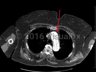 Imaging Studies image of Aortic dissection - imageId=8357567. Click to open in gallery.  caption: '<span>Axial image from CT scan of the chest demonstrating dissection of the thoracic aorta. This is a type A dissection involving the ascending and descending thoracic aorta.</span>'