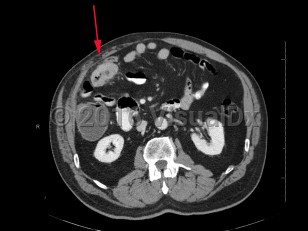 Imaging Studies image of Colon cancer - imageId=8358248. Click to open in gallery.  caption: '<span>Axial image from enhanced CT scan of the abdomen and pelvis demonstrating a thick-walled enhancing mass at the hepatic flexure.</span>'