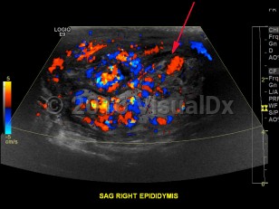 Imaging Studies image of Epididymo-orchitis - imageId=8358339. Click to open in gallery.  caption: '<span>Color Doppler ultrasound image demonstrating increased flow within the epididymis, consistent with epididymitis.</span>'