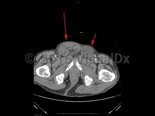 Imaging Studies image of Inguinal hernia - imageId=8359347. Click to open in gallery.  caption: '<span>Axial image from unenhanced CT scan of the pelvis demonstrates a large right inguinal hernia containing loops of non-obstructed bowel (large arrow). There is also a smaller left inguinal hernia containing fluid on the left (small arrow).</span>'